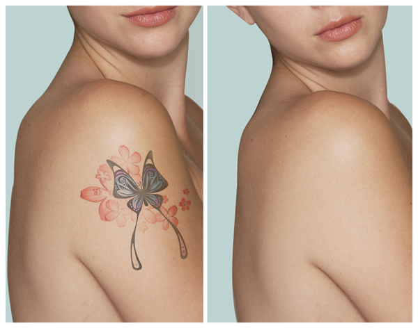 tattoolaser
